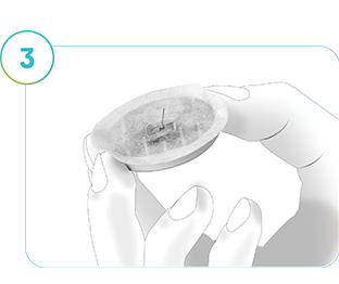 Bild som visar hur SmartGuide CGM har avlägsnats från huden.